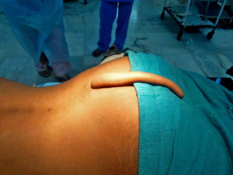 MAHARASHTRA , INDIA - OCTOBER, 03, 2016 : Before surgery picture of 18-year-old boy having 18 cm long tail, at Government Super Specialty Hospital (SSH) in Maharashtra, India. A team of neurosurgeons have successfully removed the longest recorded tail (18-cm long) from from the back of a 18-year-old boy after its abnormal growth turned painful for him. As per the doctors, the tail had grown from the posterior end of the body on the back of the boy. Pictures Supplied by : Cover Asia Press
