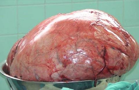 tumor-vientre-3