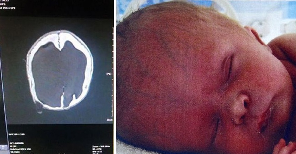 Un Milagro El Caso Del Ni o Que Naci Sin Cerebro Pero Que 4 A os un-milagro-el-caso-del-ni-o-que-naci-sin-cerebro-pero-que-4-a-os